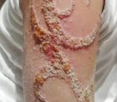 infected tattoo photo image