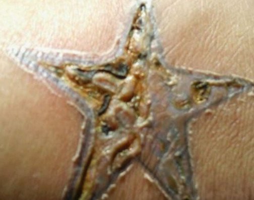 Infected Tattoo - Signs, How does it look like &amp; Treatment