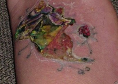 picture of tattoo infections