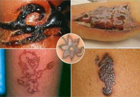 tattoo infection 