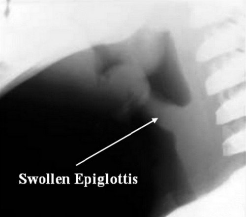 An X-ray of the neck, from the sides, can help in visualizing an enlarged epiglottis Photo