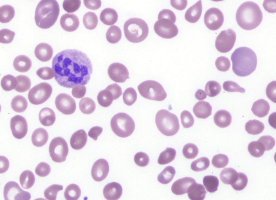 Anisocytosis