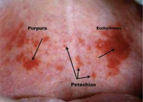 Difference between Purpura, petechiae and Ecchymosis picture image