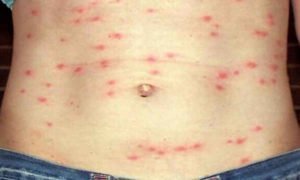 Epidemic Typhus fever rash pictures images photo | e Medical Updates