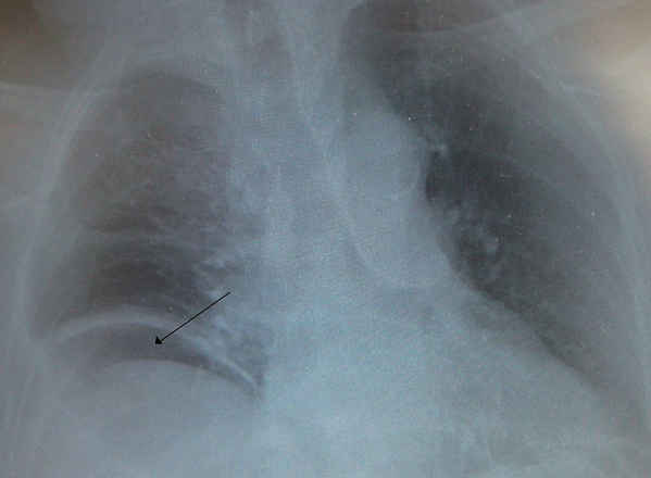 Free air under the right diaphragm from a perforated bowel abdominal erect abdomen xray