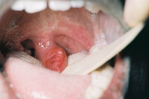 Image of a swollen uvula being examined pictures