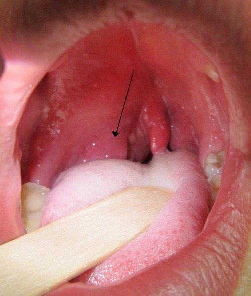 Image showing Peritonsillar abscess of the right side (arrow) photo