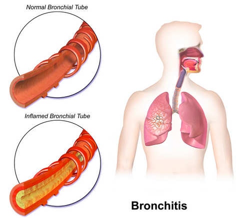 Is bronchitis contagious pcitures