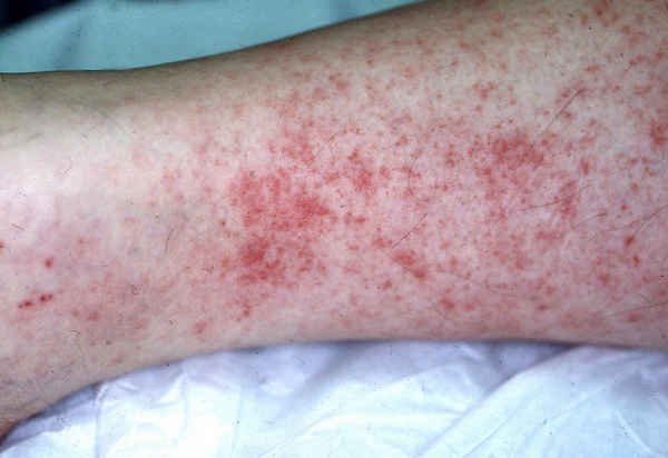 Fungal Rash On Lower Leg