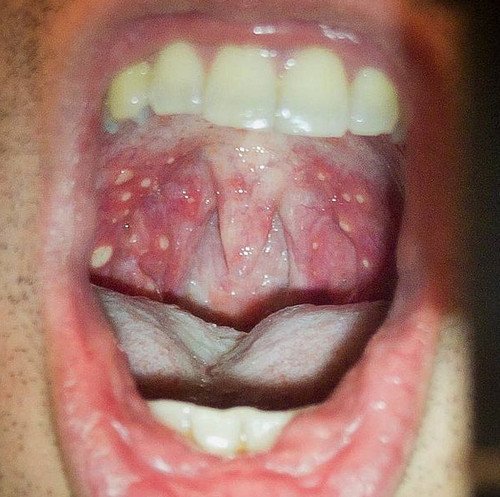 Rashes due to Hand Foot and Mouth disease can be seen in the mouth pictures