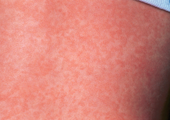 Maculopapular Rashes Causes (With Pictures)