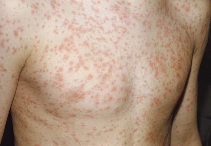 maculopapular-rashes-causes-with-pictures