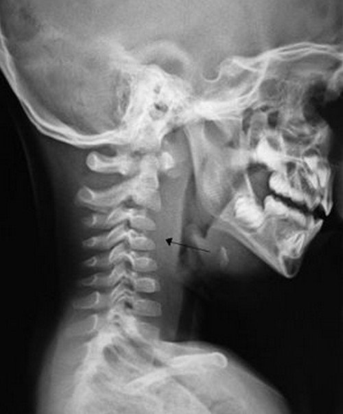 X-ray of the neck, showing soft tissue swelling (arrow) due to retropharyngeal abscess picture