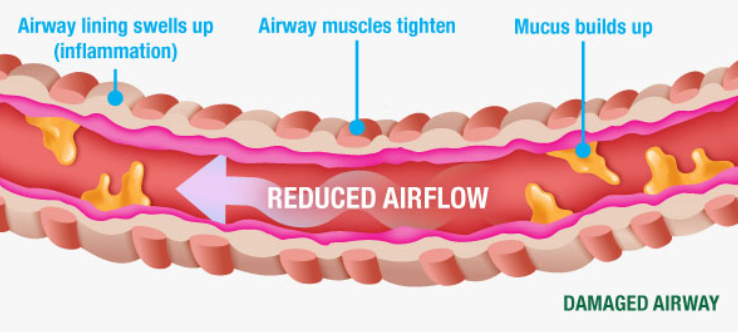 bronchitis are affecting the air passage through the bronchial tube