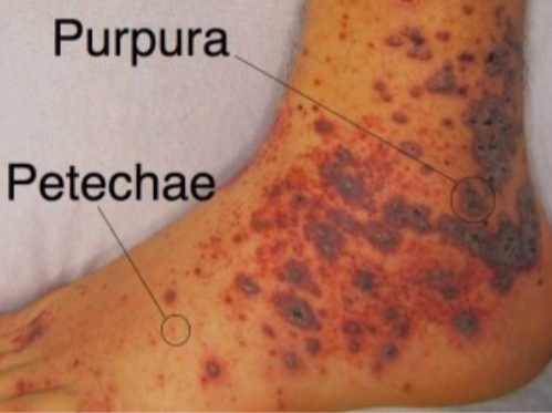 petechiae and purpura lesions on the foot and the ankle. picture