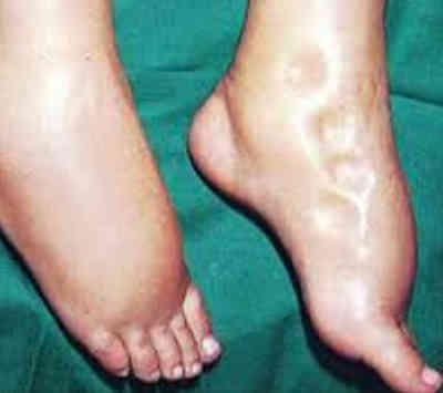 An adult with pitting edema demonstrated on the legs