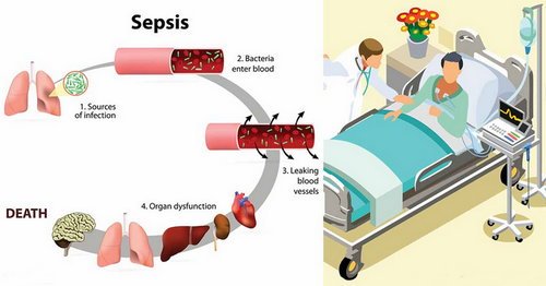 A picture demonstrating the broad pathophysiology of sepsis image photo