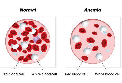 An image depicting a comparison between a normal person’s blood and an anemic person’s blood image photo picture