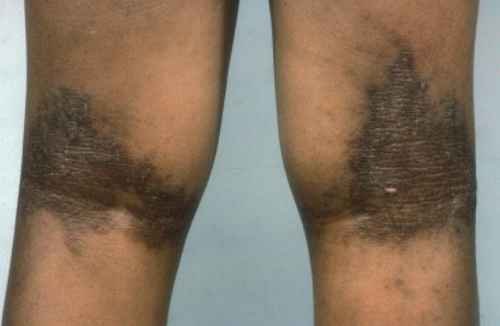 Eczema on popliteal fossa (Behind the knees) with Lichenification picture