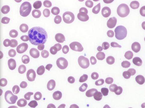 Peripheral blood film of a patient, with severe Vitamin B12 deficiency, showing marked anisocytosis image photo picture