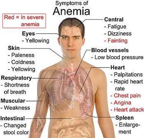 Symptoms of Anemia image photo picture