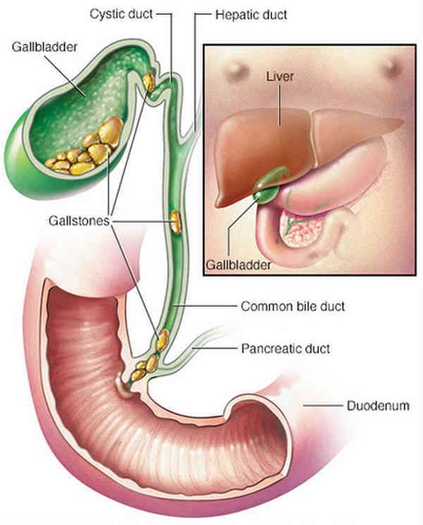 A diagrammatic representation of gallstones at different sited in the biliary tract picture image