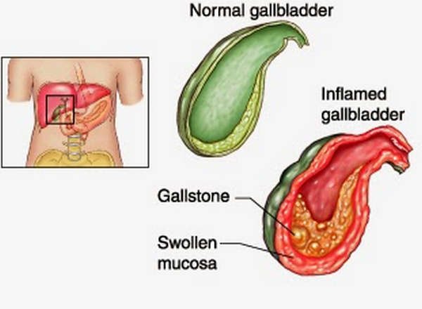 A pictorial comparison between a normal gallbladder and a gallbladder with acute cholecystitis image picture