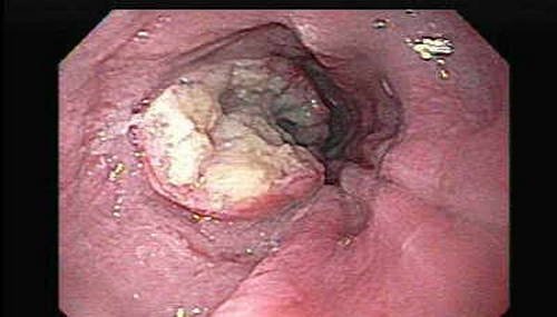 An endoscopic image of oesophagus showing cancerous growth leading to odynophagia 2