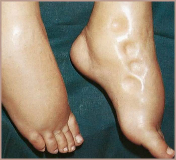 An image showing edema in a patient with fluid overload - pitting edema