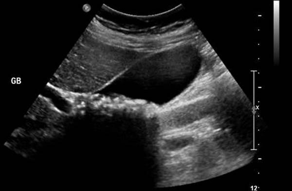 An ultrasonography showing gallstones in gallbladder