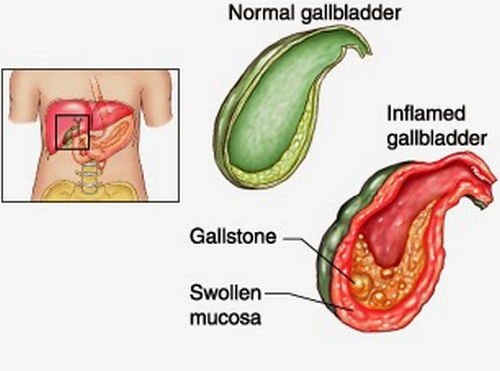 Change in gall bladder wall in acute cholecystitis