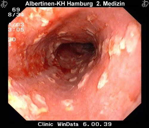 Endoscopic image of oesophagus showing herpes simplex infection 3