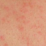 Image showing HIV rash appearance picture 1 | e Medical Updates