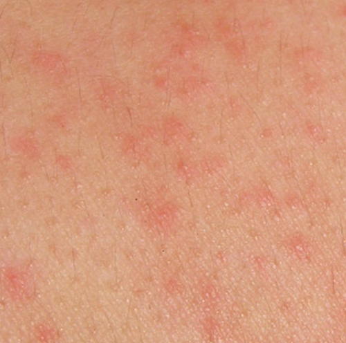HIV Rash - Pictures (Images), Symptoms, Causes and How long does it last