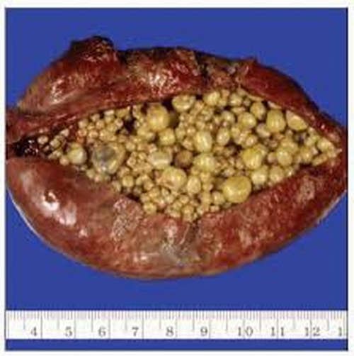 image showing a surgically removed gallbladder with multiple cholesterol stones