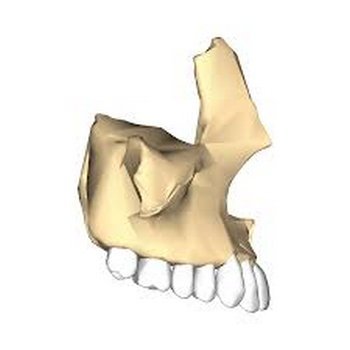 The upper jawbone holding the upper set of teeth image photo picture