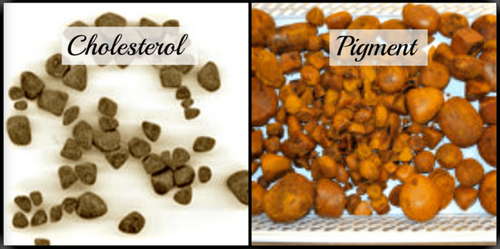 Image showing types of gallstones photo picture