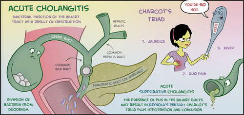 Pathogenesis of ascending cholangitis image photo picture