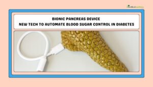 Bionic Pancreas Device- New Tech to Automate Blood Sugar Control in Diabetes