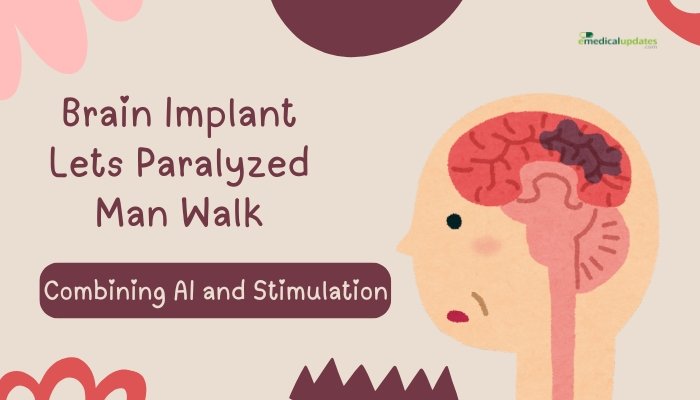 Brain Implant Lets Paralyzed Man Walk- Combining AI and Stimulation