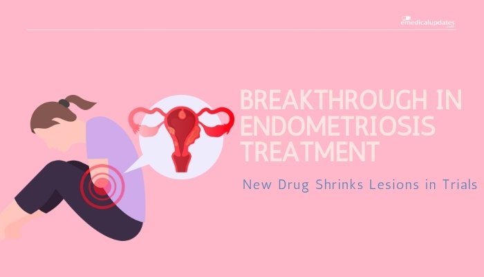 Breakthrough in Endometriosis Treatment- New Drug Shrinks Lesions in Trials